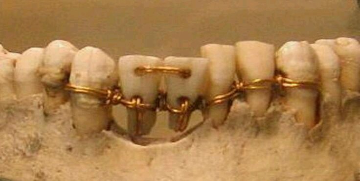 Imagem de dentes amarrados
