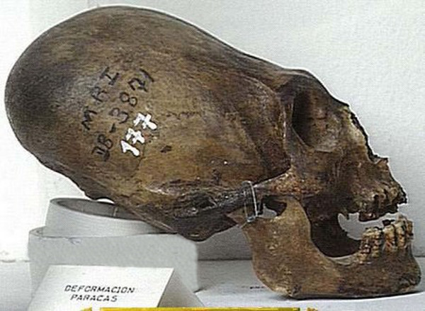 Crânio Paracas com deformação.