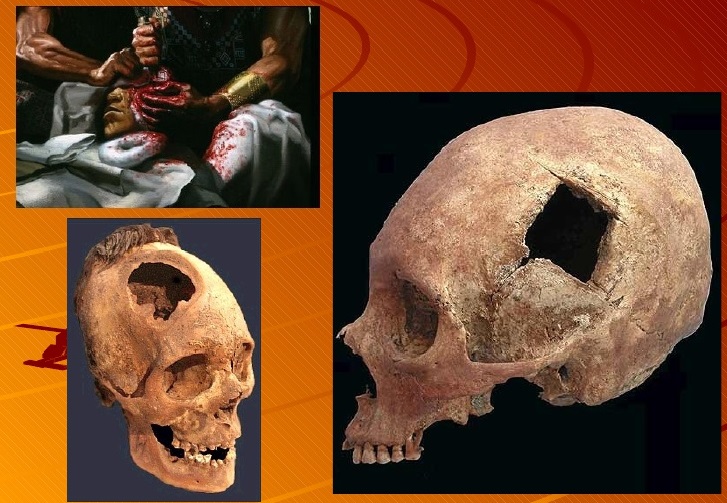 Crânios com trepanação